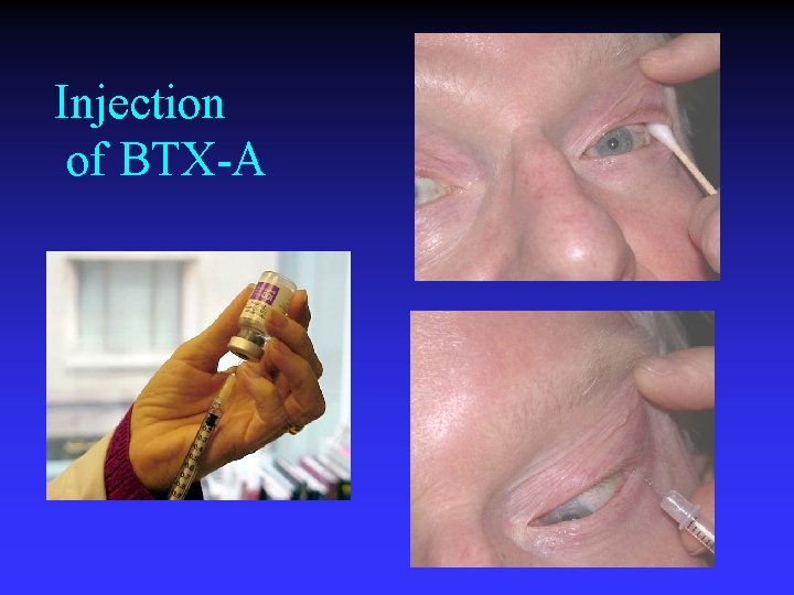 Injection of BTX-A 