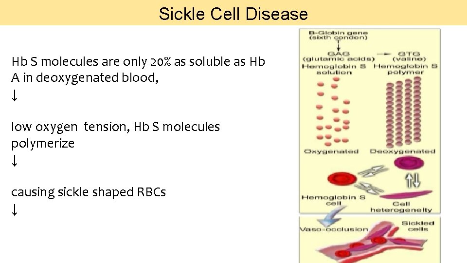 Sickle Cell Disease Hb S molecules are only 20% as soluble as Hb A