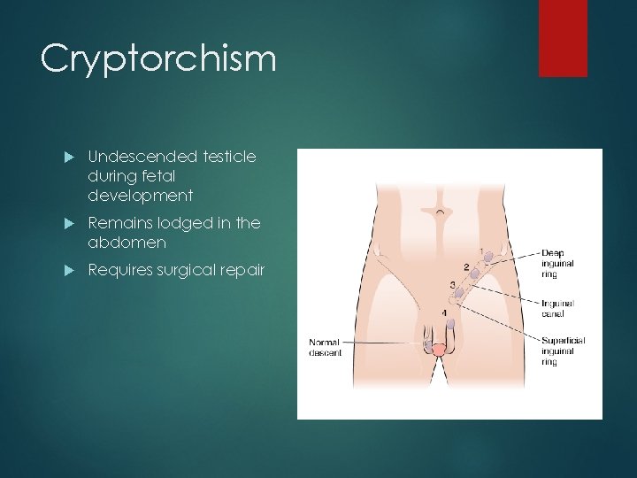 Cryptorchism Undescended testicle during fetal development Remains lodged in the abdomen Requires surgical repair