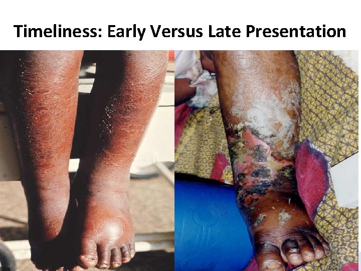 Timeliness: Early Versus Late Presentation Training Guide for Community-Based Management of Acute Malnutrition 22