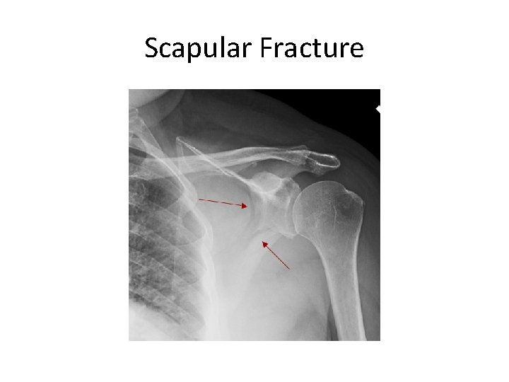 Scapular Fracture 