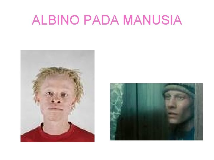 ALBINO PADA MANUSIA 