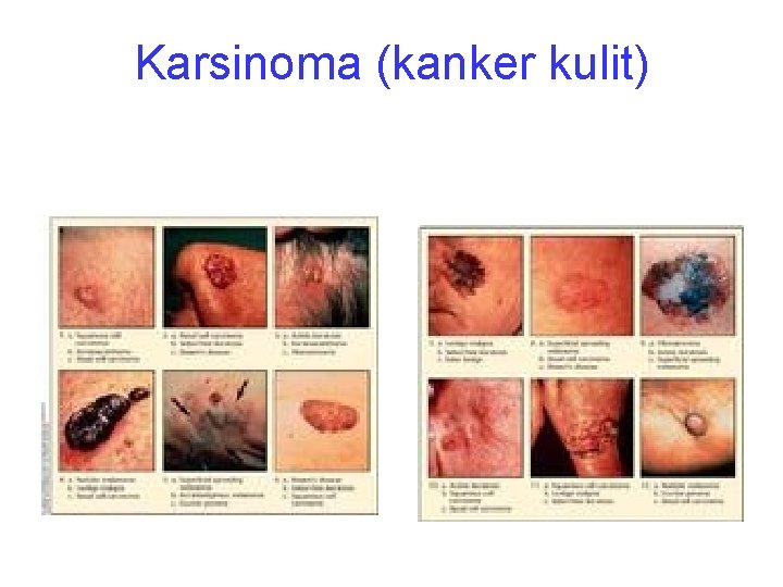 Karsinoma (kanker kulit) 