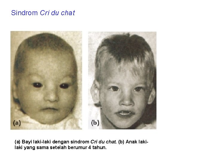 Sindrom Cri du chat (a) Bayi laki-laki dengan sindrom Cri du chat. (b) Anak