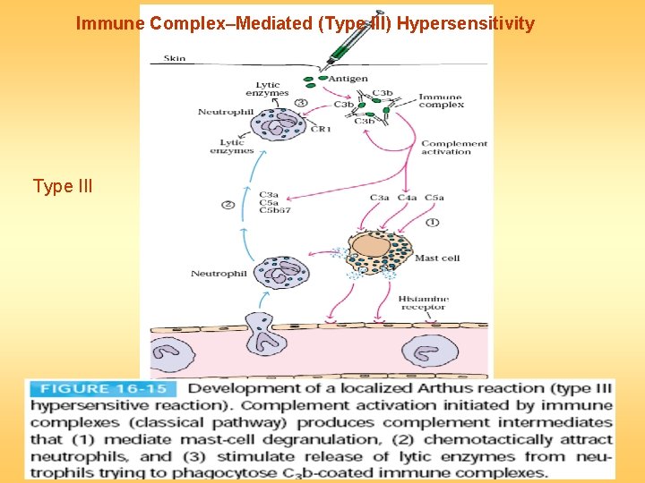 Immune Complex–Mediated (Type III) Hypersensitivity Type III 