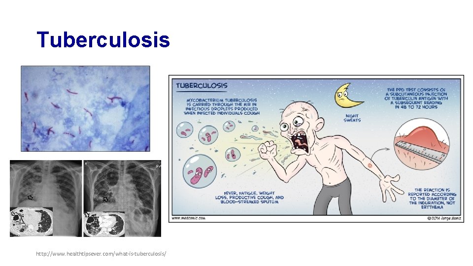 Tuberculosis http: //www. healthtipsever. com/what-is-tuberculosis/ 