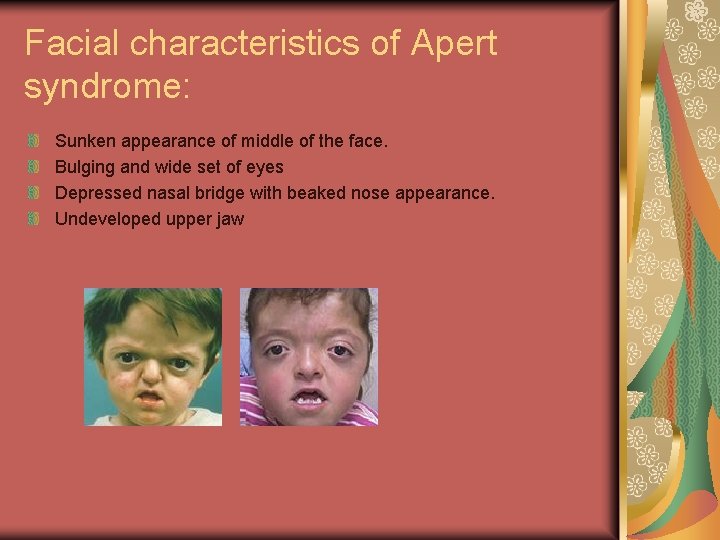 Facial characteristics of Apert syndrome: Sunken appearance of middle of the face. Bulging and