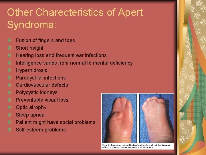 Other Charecteristics of Apert Syndrome: Fusion of fingers and toes Short height Hearing loss