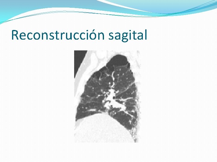 Reconstrucción sagital 
