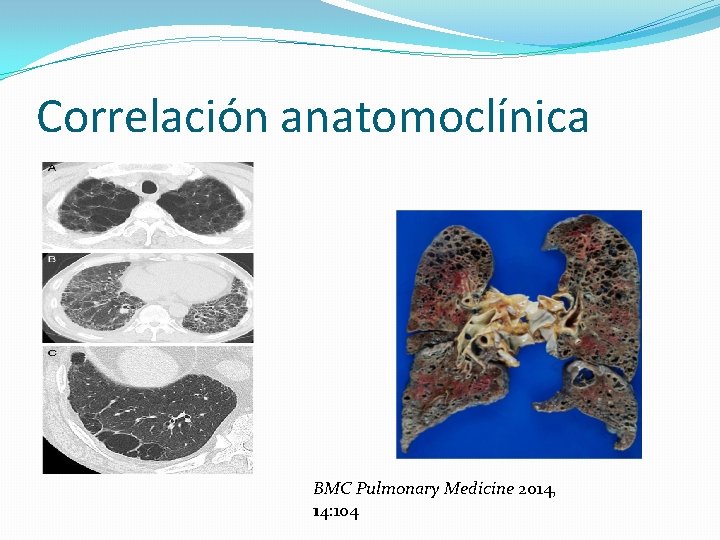 Correlación anatomoclínica BMC Pulmonary Medicine 2014, 14: 104 