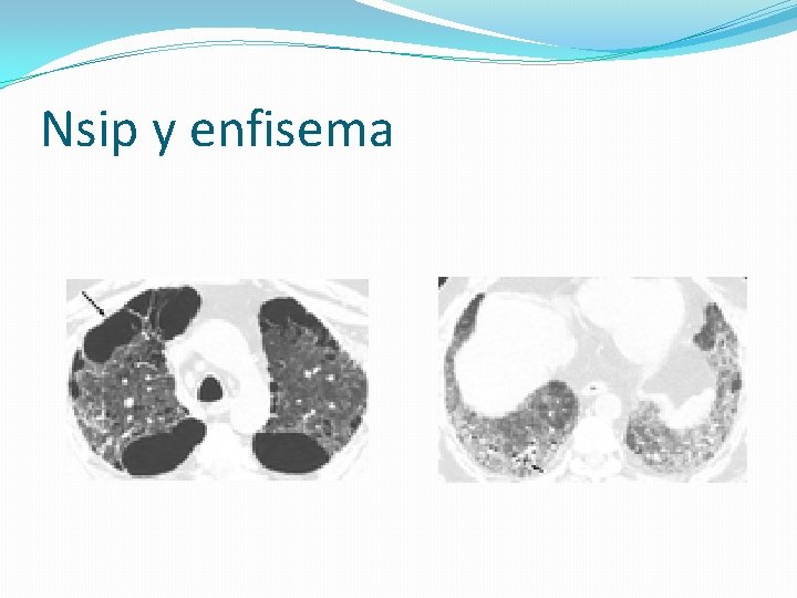 Nsip y enfisema 