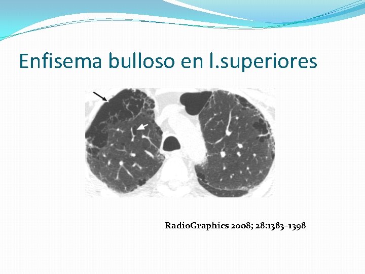 Enfisema bulloso en l. superiores Radio. Graphics 2008; 28: 1383– 1398 