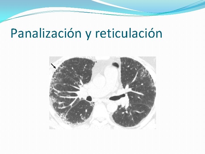 Panalización y reticulación 