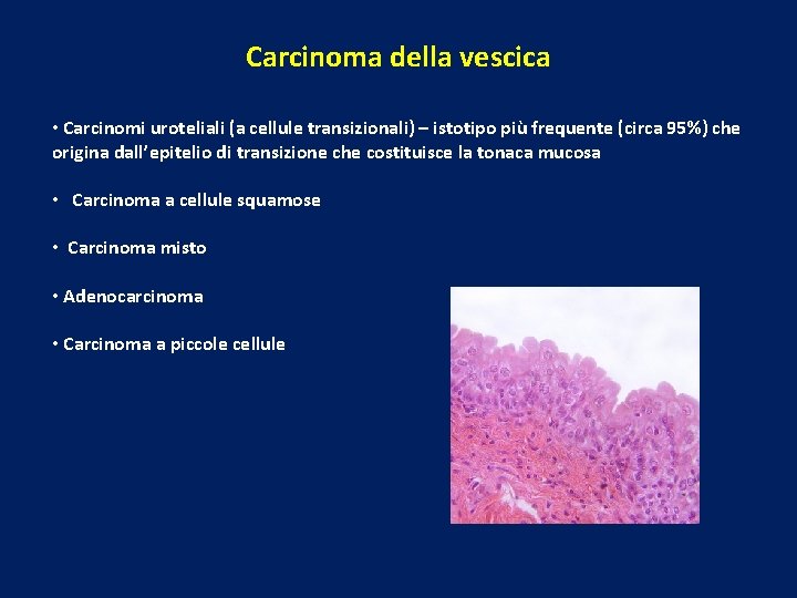 Carcinoma della vescica • Carcinomi uroteliali (a cellule transizionali) – istotipo più frequente (circa