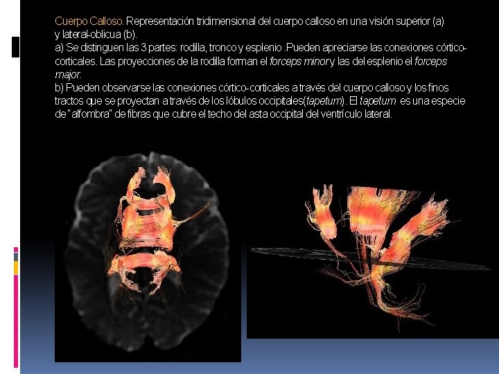 Cuerpo Calloso. Representación tridimensional del cuerpo calloso en una visión superior (a) y lateral-oblicua