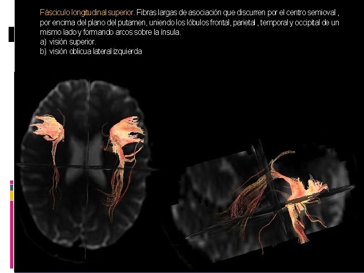 Fásciculo longitudinal superior. Fibras largas de asociación que discurren por el centro semioval ,