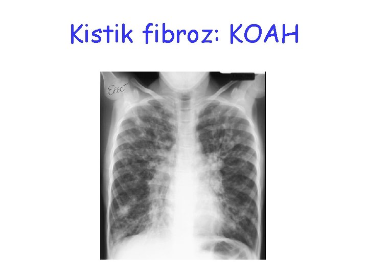 Kistik fibroz: KOAH 