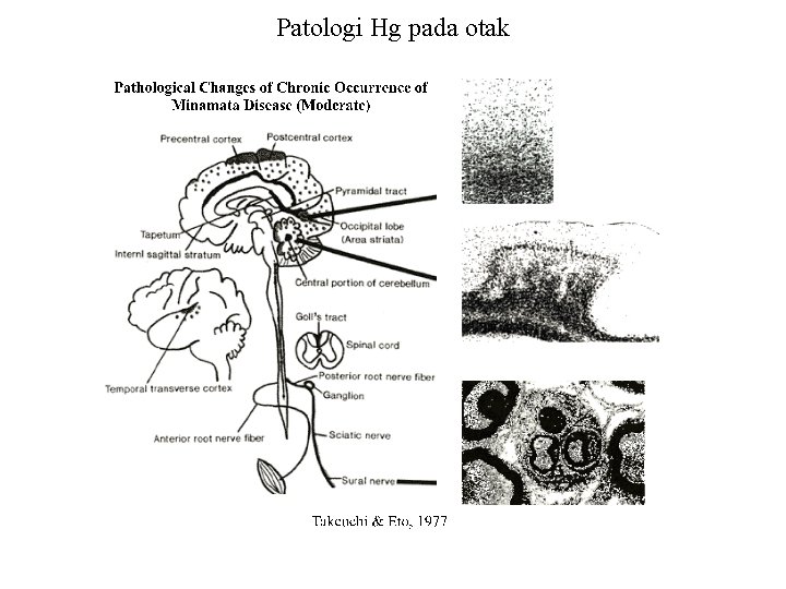 Patologi Hg pada otak 