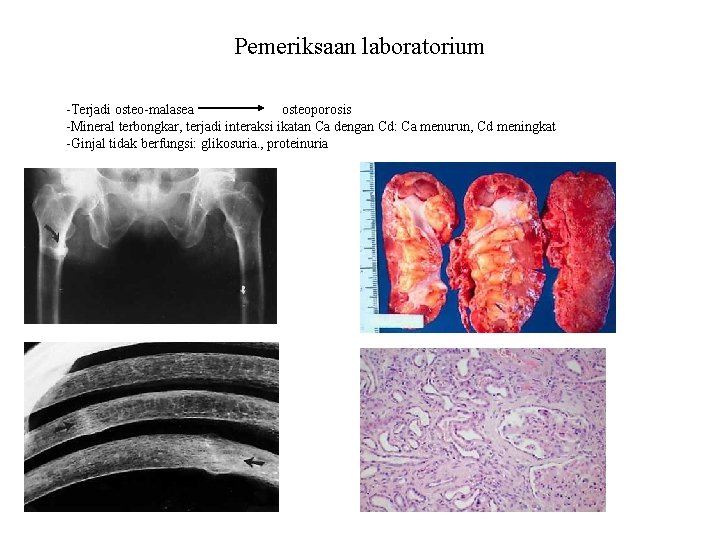 Pemeriksaan laboratorium -Terjadi osteo-malasea osteoporosis -Mineral terbongkar, terjadi interaksi ikatan Ca dengan Cd: Ca