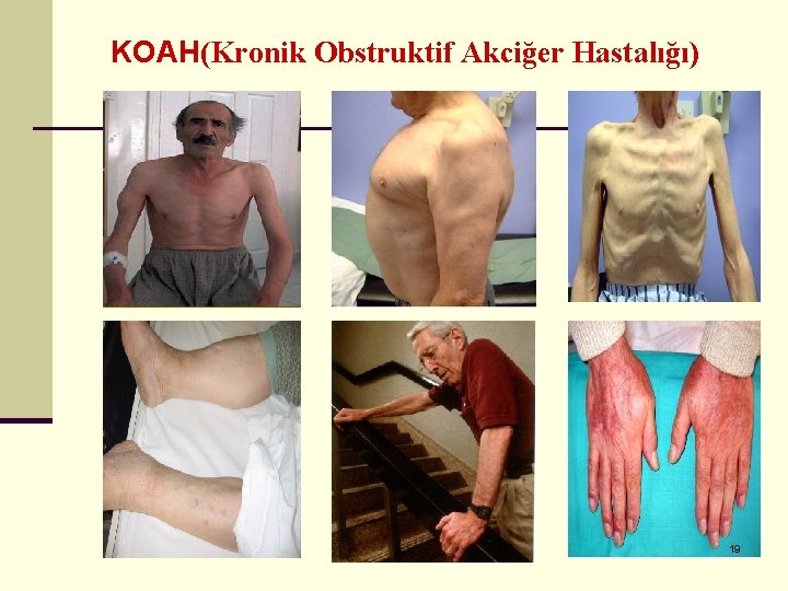 KOAH(Kronik Obstruktif Akciğer Hastalığı) 19 