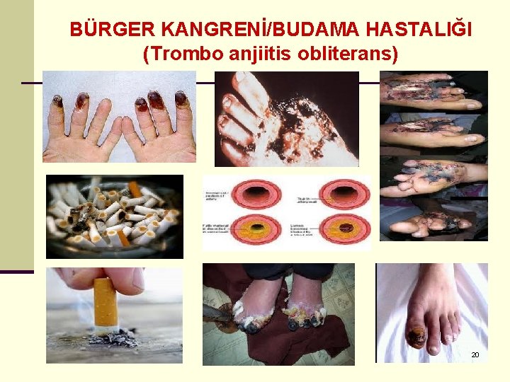 BÜRGER KANGRENİ/BUDAMA HASTALIĞI (Trombo anjiitis obliterans) 20 