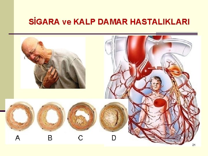 SİGARA ve KALP DAMAR HASTALIKLARI 21 