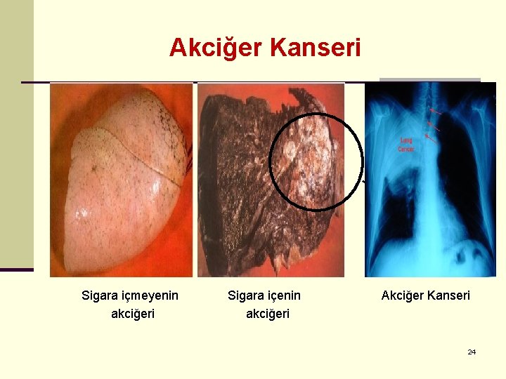 Akciğer Kanseri Kanserli Bölge Sigara içmeyenin akciğeri Sigara içenin akciğeri Akciğer Kanseri 24 