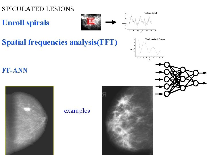 SPICULATED LESIONS Unroll spirals Spatial frequencies analysis(FFT) FF-ANN examples 