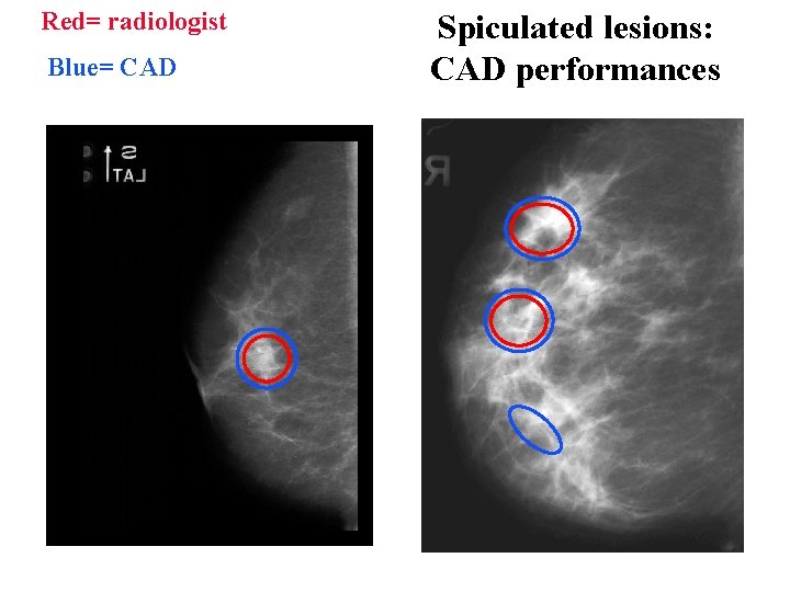 Red= radiologist Blue= CAD Spiculated lesions: CAD performances 