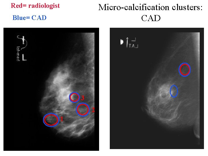Red= radiologist Micro-calcification clusters: CAD Blue= CAD 3 2 1 