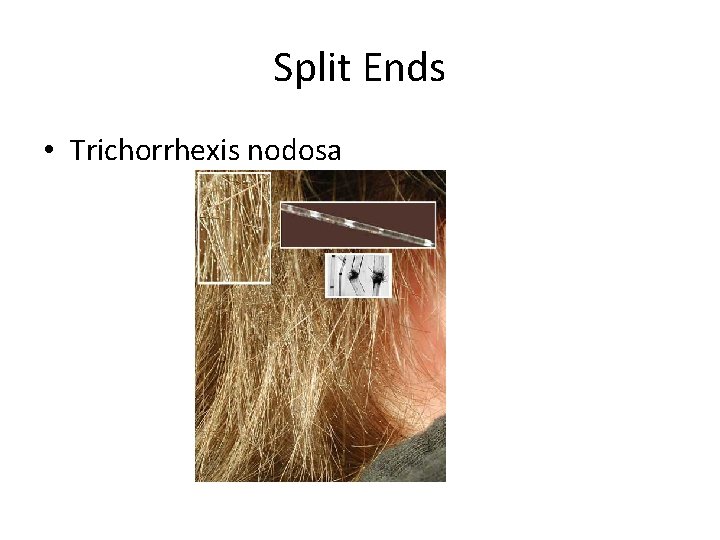 Split Ends • Trichorrhexis nodosa 