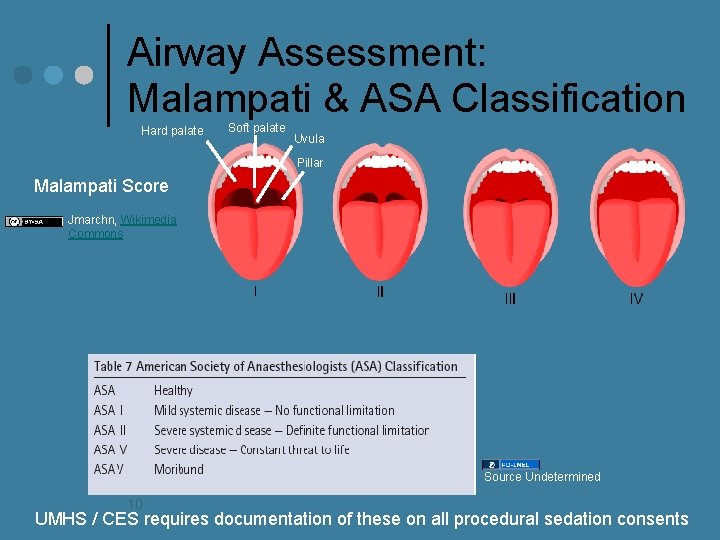 Airway Assessment: Malampati & ASA Classification Hard palate Soft palate Uvula Pillar Malampati Score