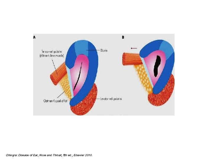 Dhingra: Disease of Ear, Nose and Throat, 5 th ed. , Elsevier 2010. 