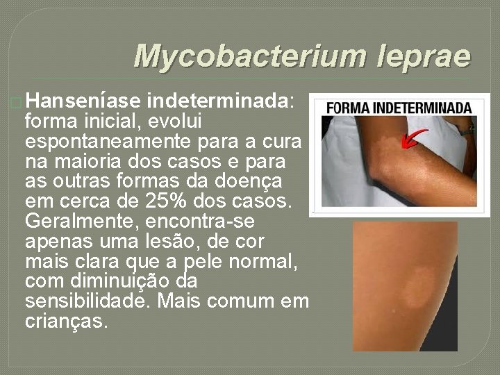 Mycobacterium leprae � Hanseníase indeterminada: forma inicial, evolui espontaneamente para a cura na maioria