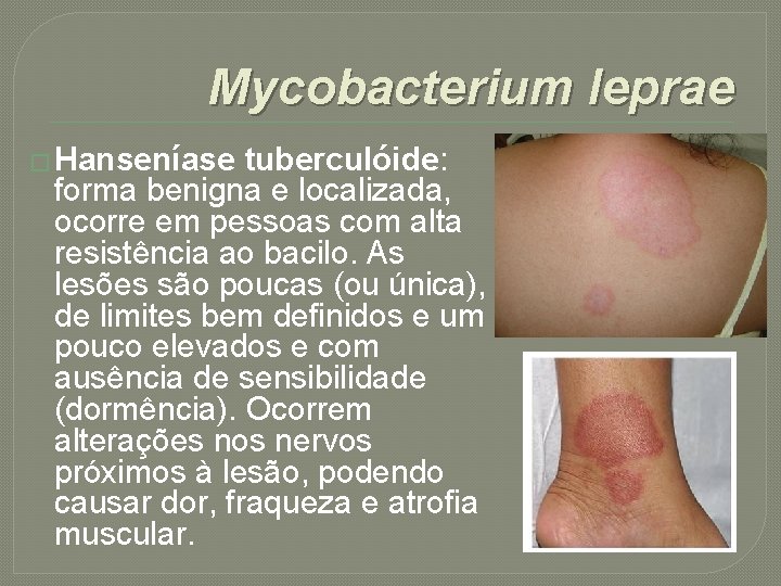 Mycobacterium leprae � Hanseníase tuberculóide: forma benigna e localizada, ocorre em pessoas com alta