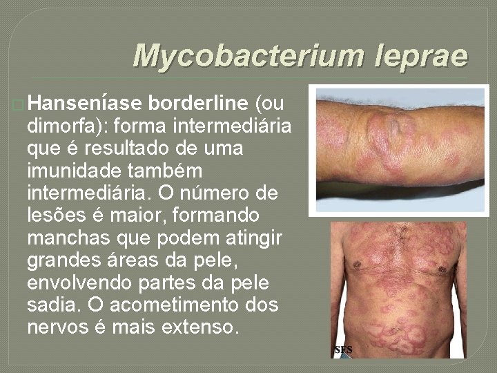 Mycobacterium leprae � Hanseníase borderline (ou dimorfa): forma intermediária que é resultado de uma