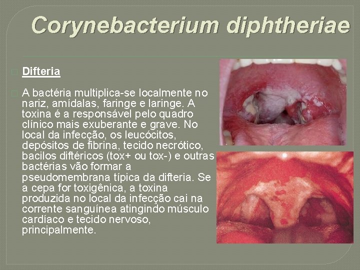 Corynebacterium diphtheriae � Difteria � A bactéria multiplica-se localmente no nariz, amídalas, faringe e