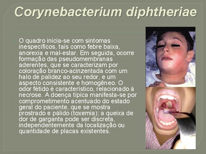 Corynebacterium diphtheriae � O quadro inicia-se com sintomas inespecíficos, tais como febre baixa, anorexia