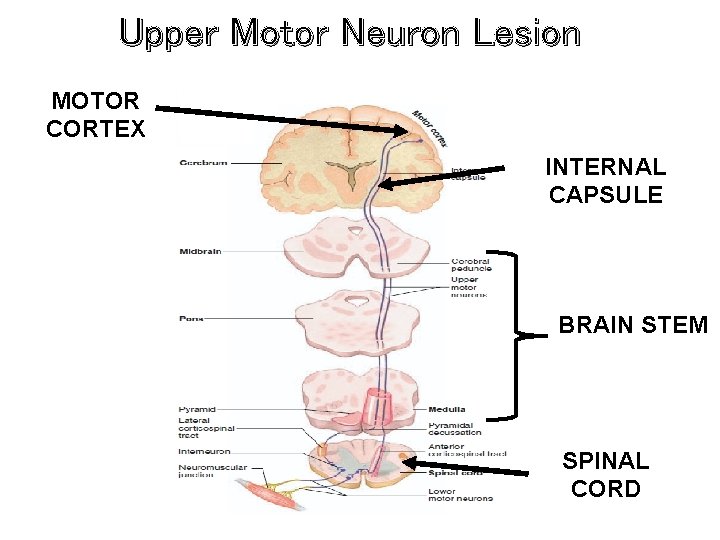 Upper Motor Neuron Lesion MOTOR CORTEX INTERNAL CAPSULE BRAIN STEM SPINAL CORD 