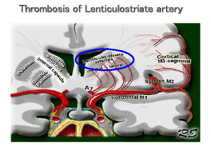 Thrombosis of Lenticulostriate artery 