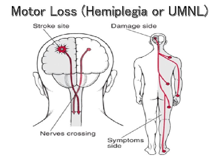 Motor Loss (Hemiplegia or UMNL) 