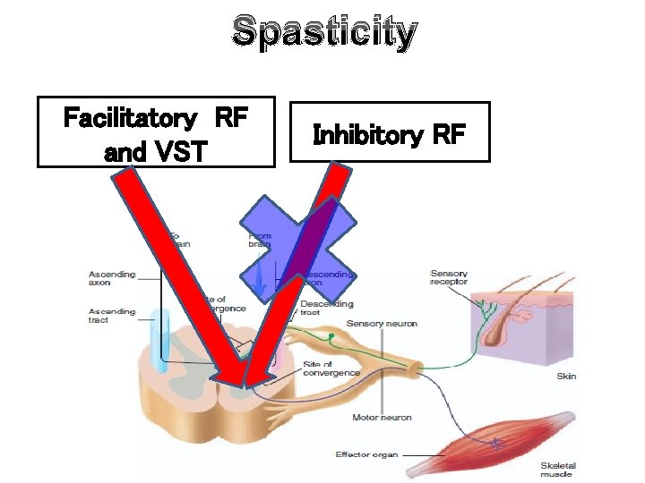 Spasticity Facilitatory RF and VST Inhibitory RF 