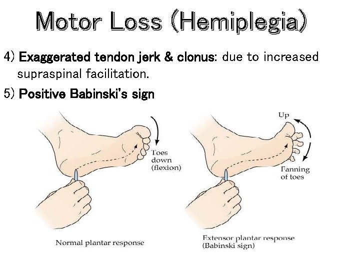 Motor Loss (Hemiplegia) 4) Exaggerated tendon jerk & clonus: due to increased supraspinal facilitation.