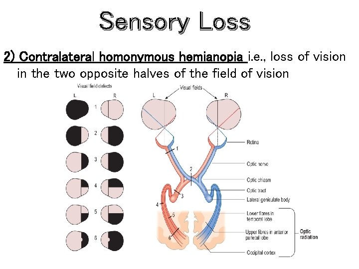 Sensory Loss 2) Contralateral homonymous hemianopia i. e. , loss of vision in the