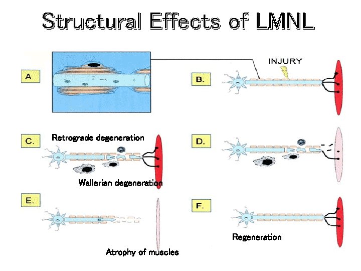 Structural Effects of LMNL Retrograde degeneration Wallerian degeneration Regeneration Atrophy of muscles 