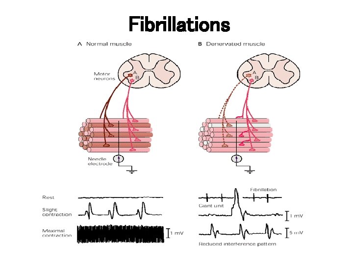 Fibrillations 