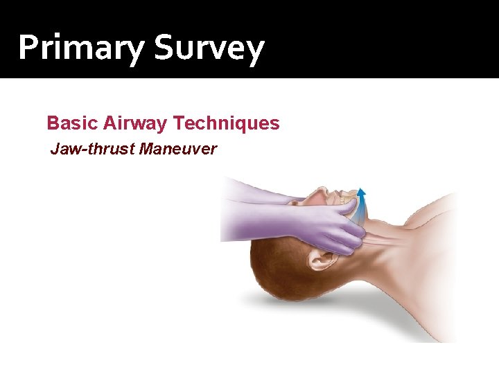 Primary Survey Basic Airway Techniques Jaw-thrust Maneuver 