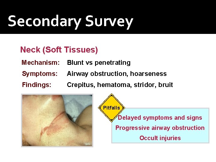 Secondary Survey Neck (Soft Tissues) Mechanism: Blunt vs penetrating Symptoms: Airway obstruction, hoarseness Findings: Secondary Survey Neck (Soft Tissues) Mechanism: Blunt vs penetrating Symptoms: Airway obstruction, hoarseness Findings: