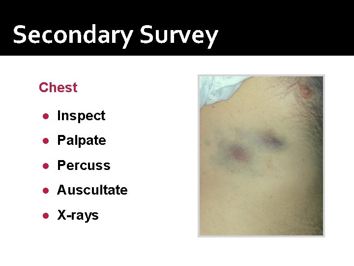 Secondary Survey Chest ● Inspect ● Palpate ● Percuss ● Auscultate ● X-rays Secondary Survey Chest ● Inspect ● Palpate ● Percuss ● Auscultate ● X-rays