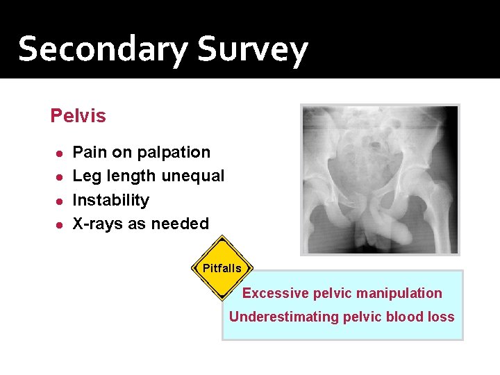 Secondary Survey Pelvis Pain on palpation ● Leg length unequal ● Instability ● X-rays